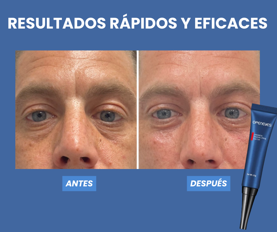 Elimina las ojeras y bolsas de tus ojos - OpenEye™ | 1+1 GRATIS 🎁