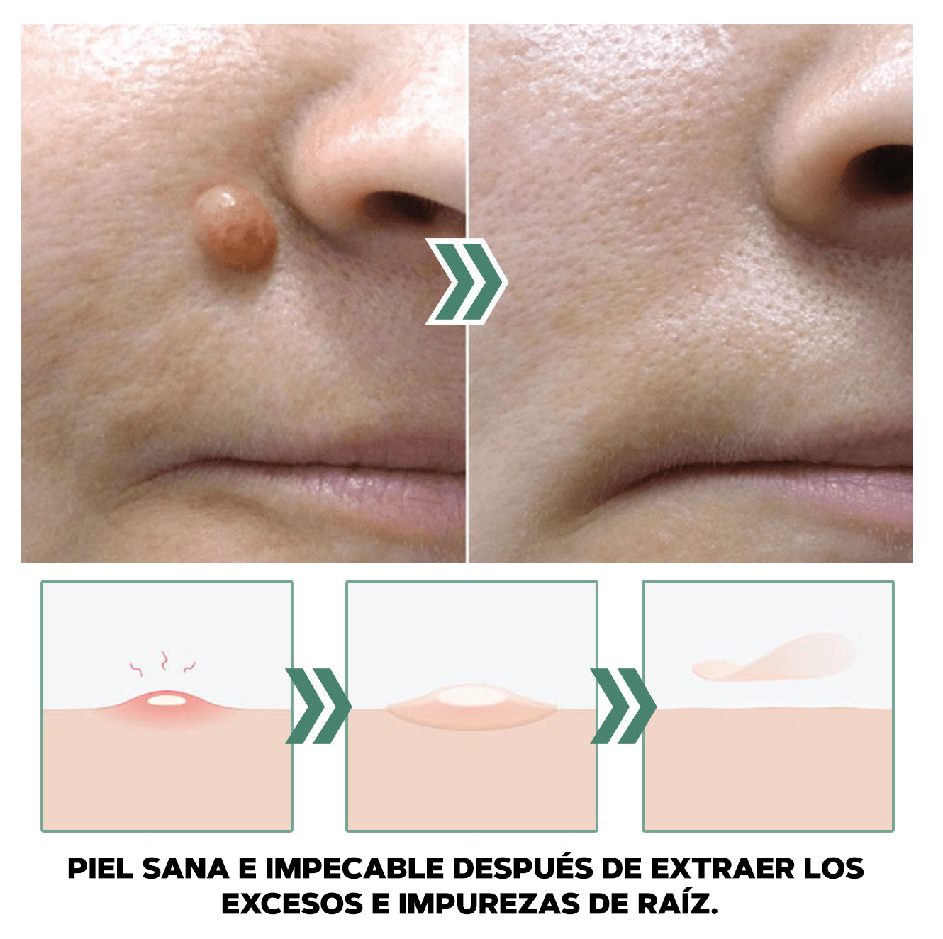 Elimina tus verrugas sin dolor - SkinTag™ | 50% DESCUENTO