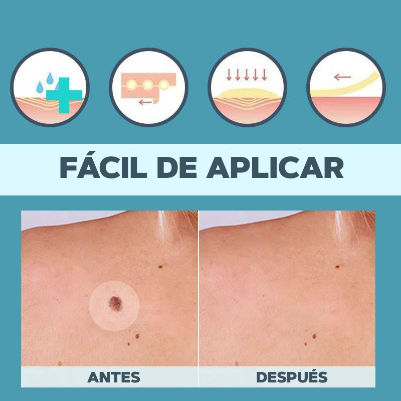 Elimina tus verrugas sin dolor - SkinTag™ | 50% DESCUENTO