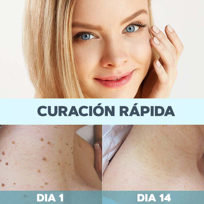 Elimina tus verrugas sin dolor - SkinTag™ | 50% DESCUENTO