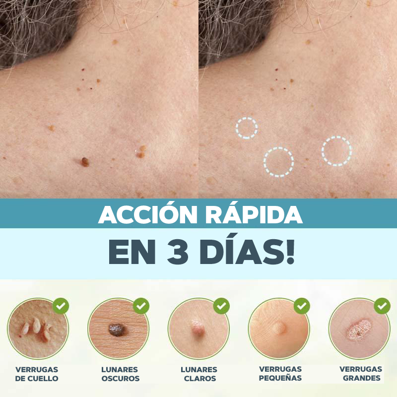 Elimina tus verrugas sin dolor - SkinTag™ | 50% DESCUENTO