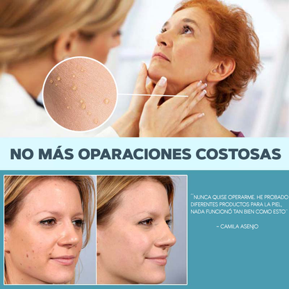 Elimina tus verrugas sin dolor - SkinTag™ | 50% DESCUENTO